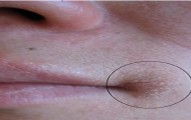 Home Remedy Cure for Angular Cheilitis
